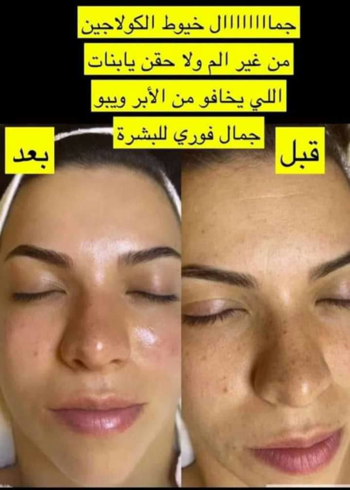 خيوط الكولاجين الذهبية 3